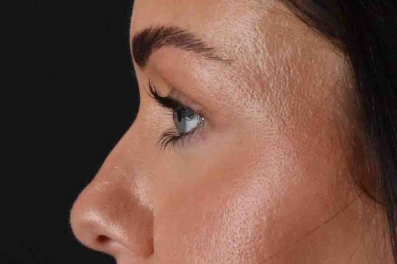 Blepharoplasty (Eyelid Surgery) Before & After Patient #4503