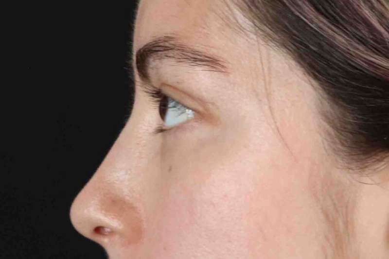 Blepharoplasty (Eyelid Surgery) Before & After Patient #4514