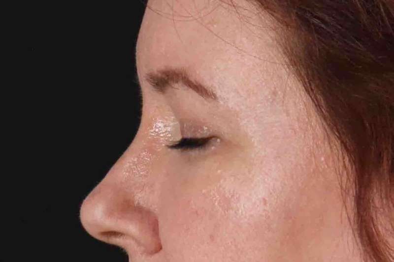 Blepharoplasty (Eyelid Surgery) Before & After Patient #4536