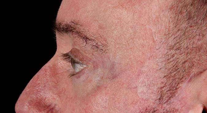Blepharoplasty (Eyelid Surgery) Before & After Patient #4599