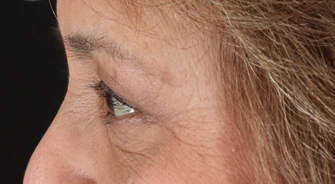 Blepharoplasty (Eyelid Surgery) Before & After Patient #4649