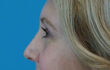 Brow Lift Before & After Patient #4672