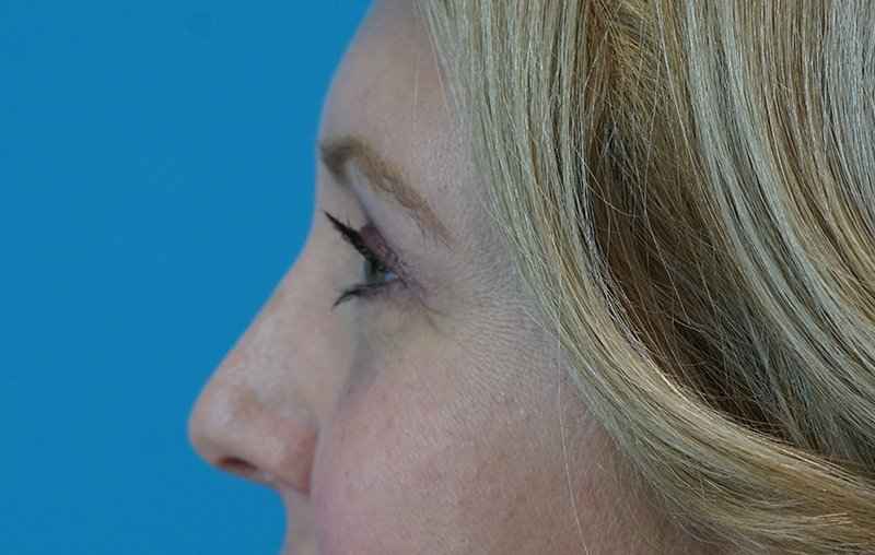 Brow Lift Before & After Patient #4672