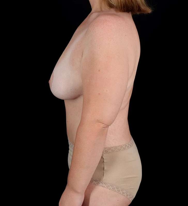 Abdominoplasty (Tummy Tuck) Before & After Patient #1001
