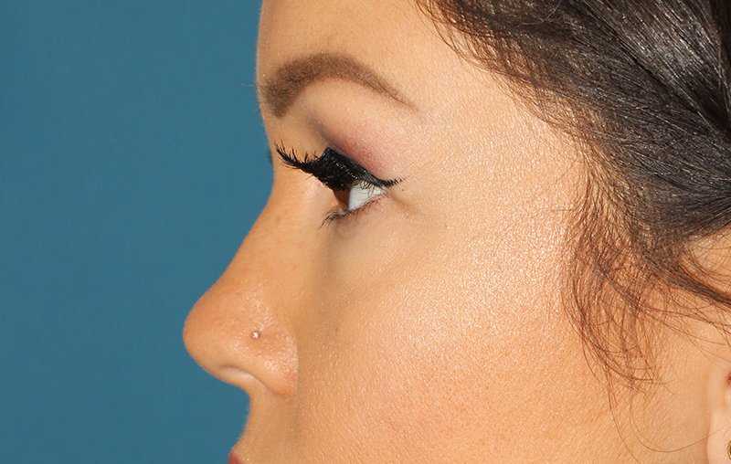 Brow Lift Before & After Patient #4690