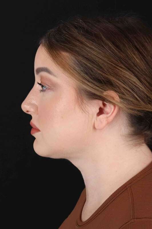 Brow Lift Before & After Patient #4722