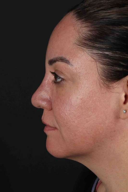 Brow Lift Before & After Patient #4733