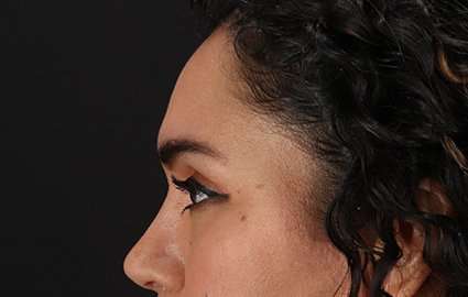 Brow Lift Before & After Patient #4744