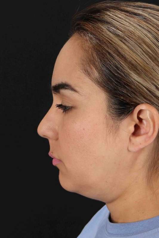 Brow Lift Before & After Patient #4755