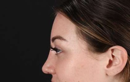 Brow Lift Before & After Patient #4766