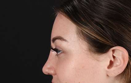 Brow Lift Before & After Patient #4766