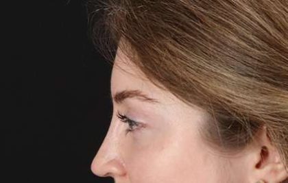 Brow Lift Before & After Patient #4777
