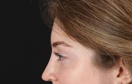 Brow Lift Before & After Patient #4777