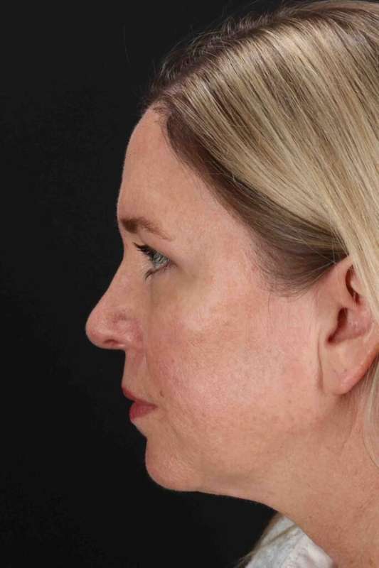 Brow Lift Before & After Patient #4810