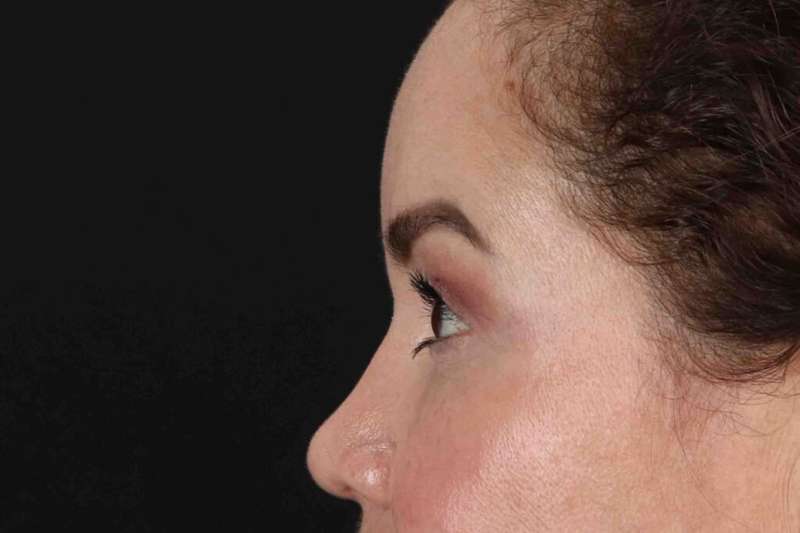 Brow Lift Before & After Patient #4843