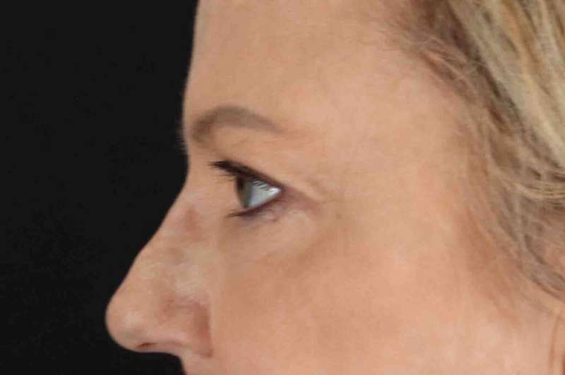 Brow Lift Before & After Patient #4854