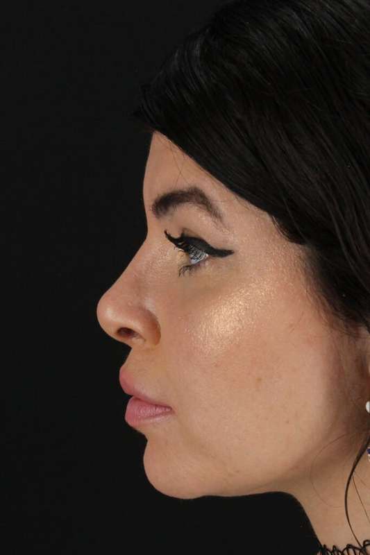 Brow Lift Before & After Patient #4912