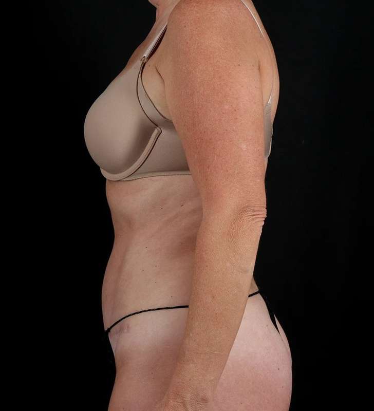 Abdominoplasty (Tummy Tuck) Before & After Patient #1029