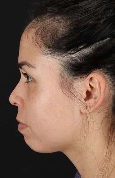 Cosmetic Injectables Before & After Patient #4990