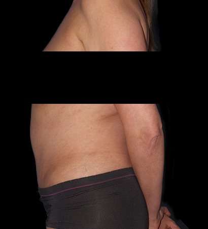 Abdominoplasty (Tummy Tuck) Before & After Patient #590