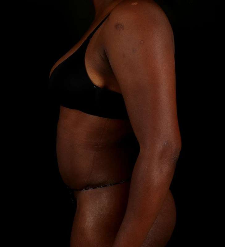 Abdominoplasty (Tummy Tuck) Before & After Patient #1045