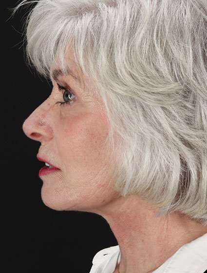 Facelift Before & After Patient #5174