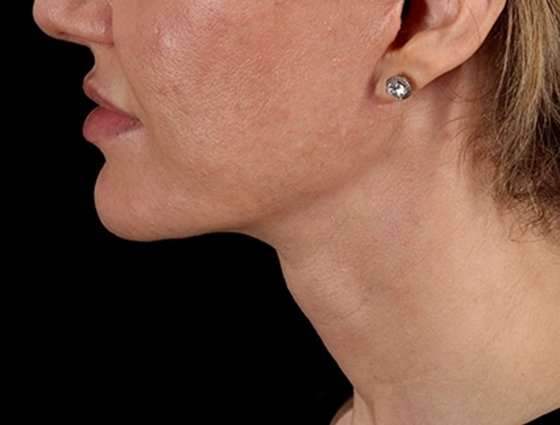 Facelift Before & After Patient #5185