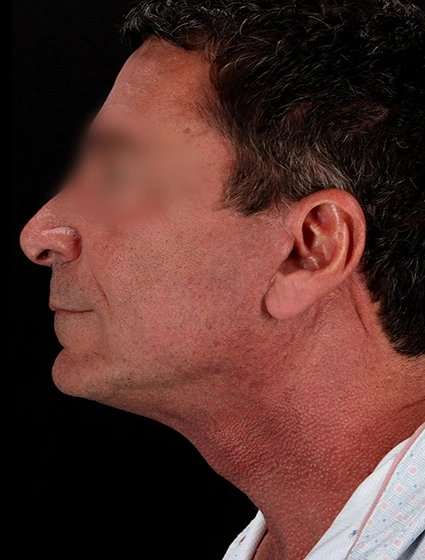 Facelift Before & After Patient #5207
