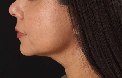 Facelift Before & After Patient #5251