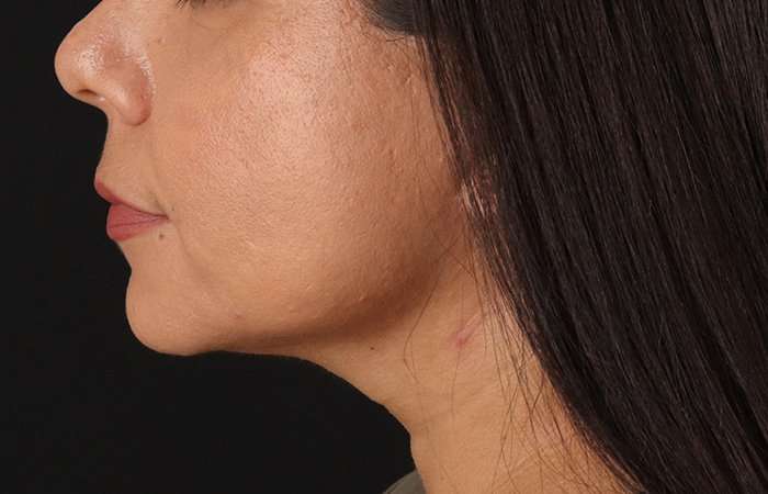 Facelift Before & After Patient #5251