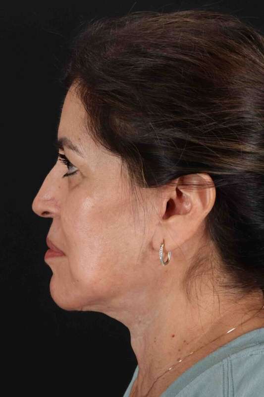 Facelift Before & After Patient #5284