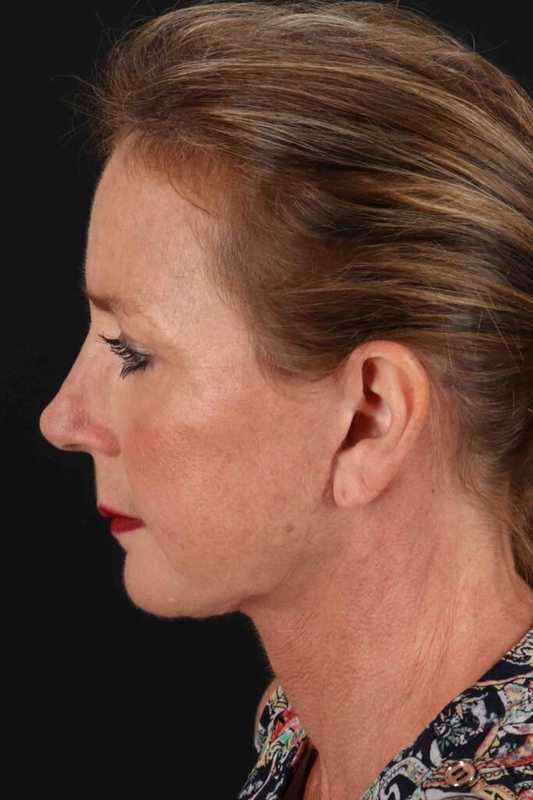Facelift Before & After Patient #5295