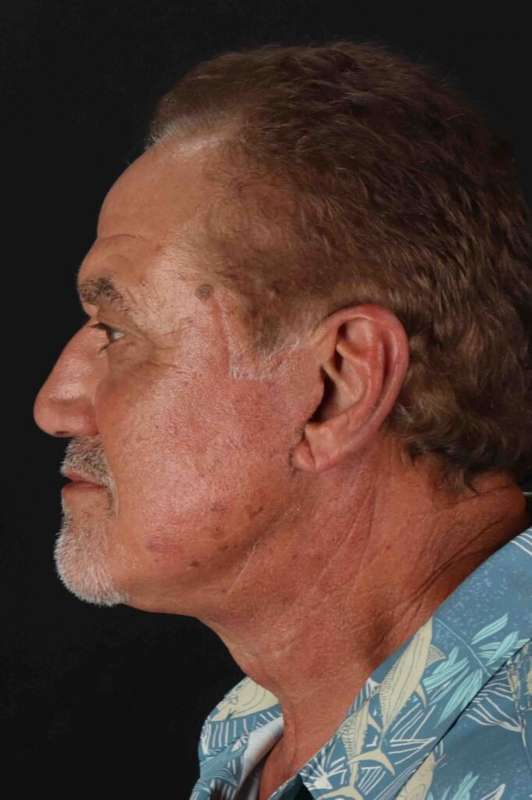 Facelift Before & After Patient #5306