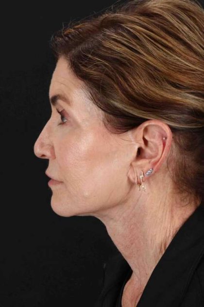 Facelift Before & After Patient #5337