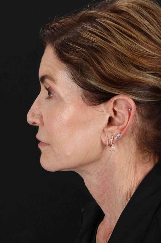 Facelift Before & After Patient #5337