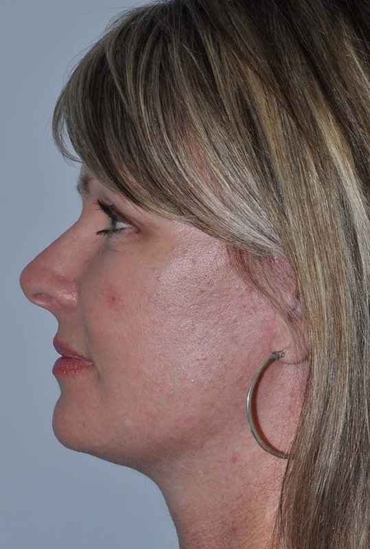 Facelift Before & After Patient #5385