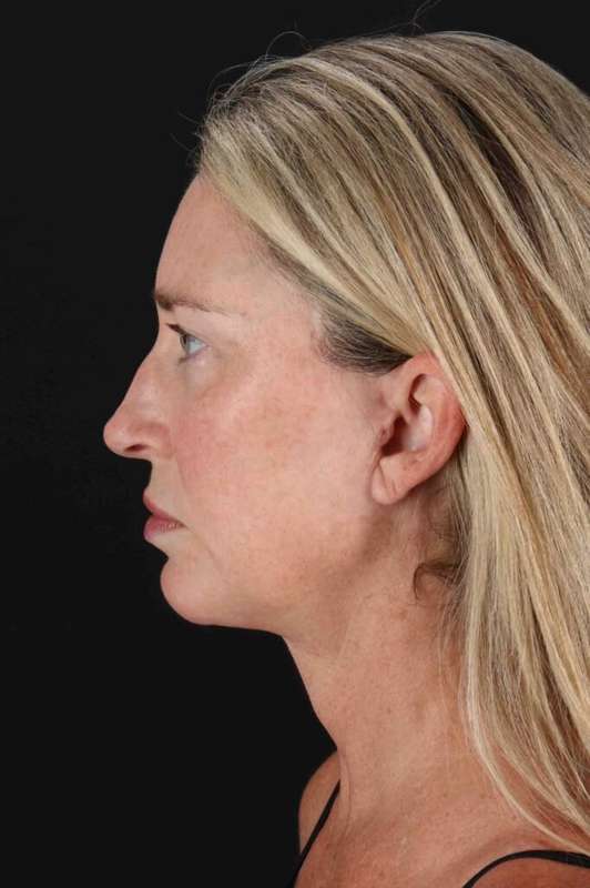 Facelift Before & After Patient #5488