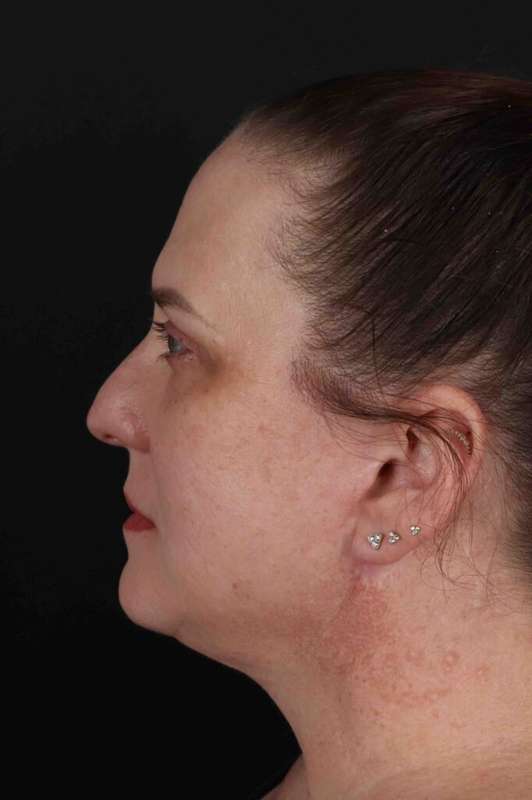 Facelift Before & After Patient #5521