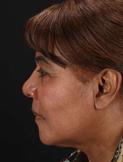 Chemical Peels Before & After Patient #5554