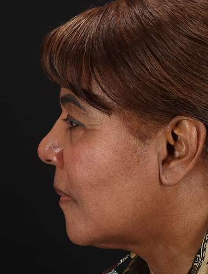 Chemical Peels Before & After Patient #5554