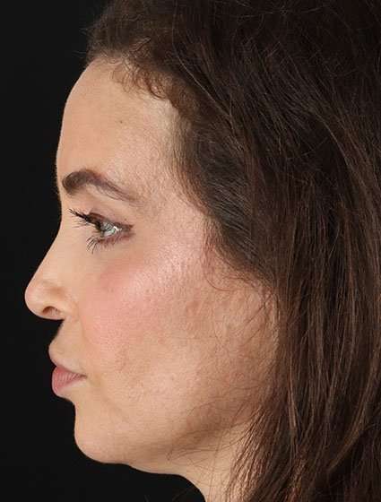 Chemical Peels Before & After Patient #5579