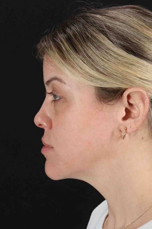 Chemical Peels Before & After Patient #5601