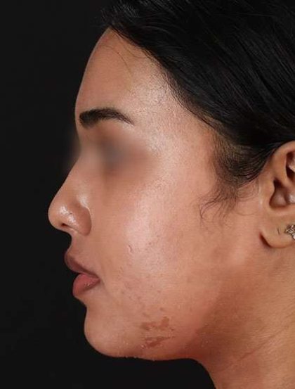 Chemical Peels Before & After Patient #5621