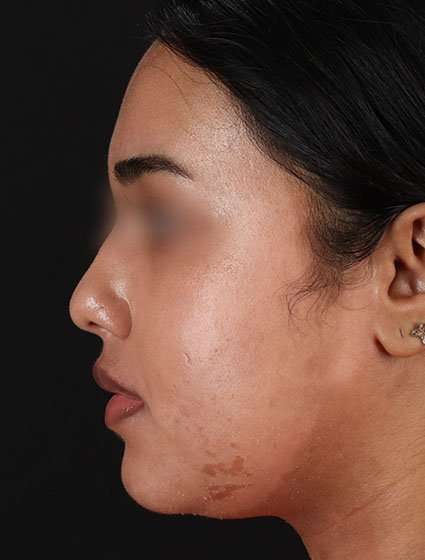 Chemical Peels Before & After Patient #5621