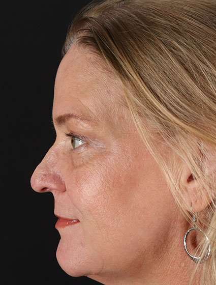 Chemical Peels Before & After Patient #5632
