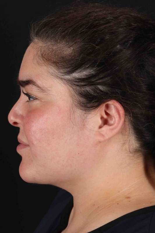 Neck Liposuction Before & After Patient #5643