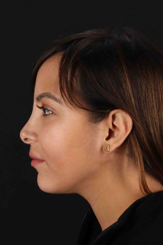 Neck Liposuction Before & After Patient #5654