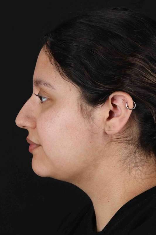 Neck Liposuction Before & After Patient #5665
