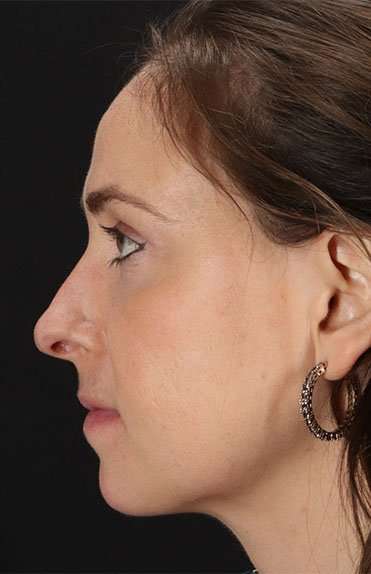 Neck Liposuction Before & After Patient #5687