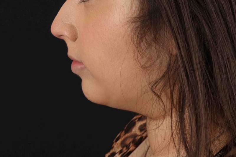Neck Liposuction Before & After Patient #5698